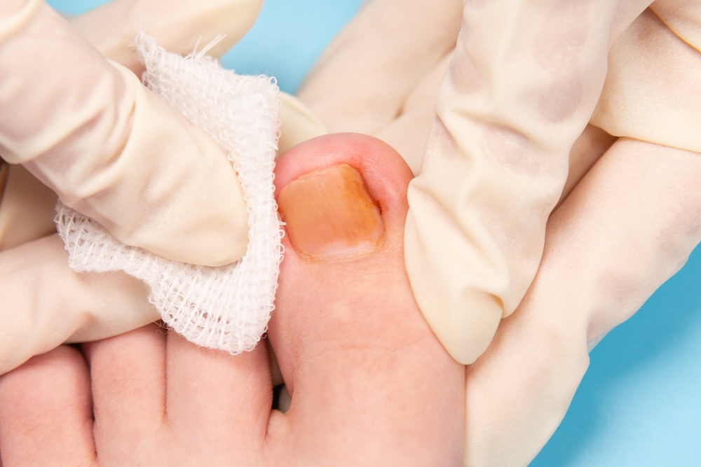 Ingrown Toenails Treatment Ingrown Toenail