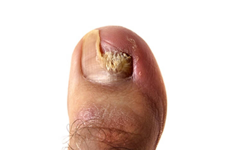 Toenail Fungus Symptoms